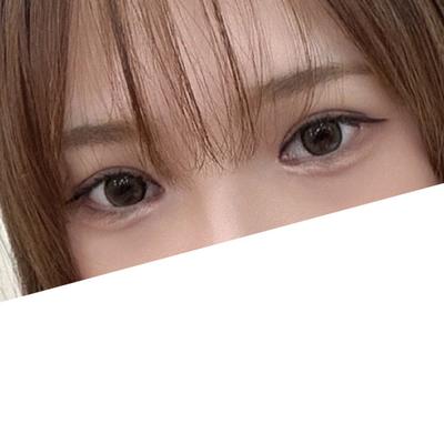 쌍꺼풀 재수술 1개월, 꼬막눈 사라지고 눈이 시원해졌어요 — 아바성형외과 환자 후기 사진
