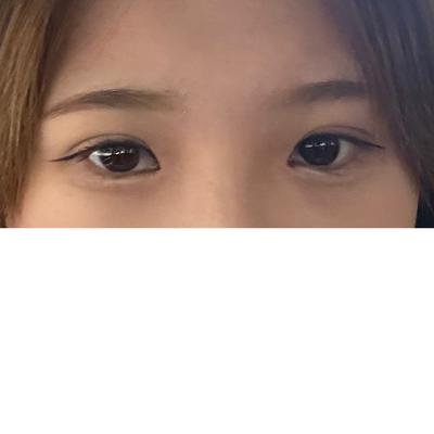 쌍꺼풀 재수술 1개월, 꼬막눈 사라지고 눈이 시원해졌어요 사진 3 — 아바성형외과 쌍꺼풀·눈성형 후기