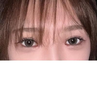 쌍꺼풀 재수술 1개월, 꼬막눈 사라지고 눈이 시원해졌어요 사진 4 — 아바성형외과 쌍꺼풀·눈성형 후기