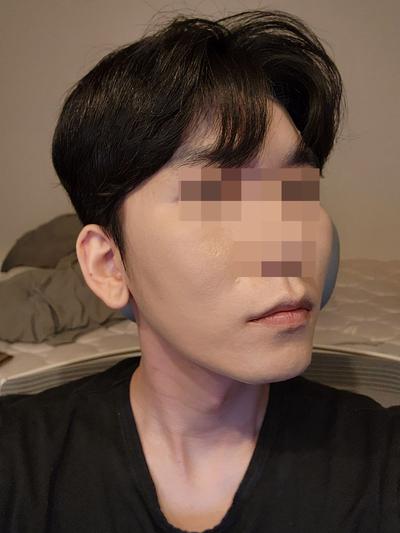 광대 사각턱 비대칭교정에 거상까지 한달 반, 인상 부드러워졌대요 사진 2 — 아바성형외과 안면거상 후기