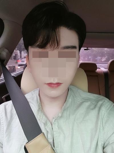 광대 사각턱 비대칭교정에 거상까지 한달 반, 인상 부드러워졌대요 사진 4 — 아바성형외과 안면거상 후기