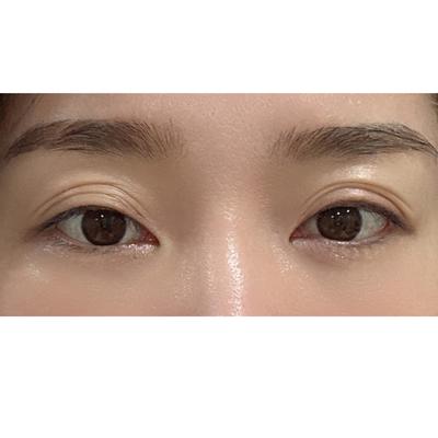 절개 쌍꺼풀 한 달차, 원했던 얇은 인라인 그대로 나왔어요 — 아바성형외과 환자 후기 사진