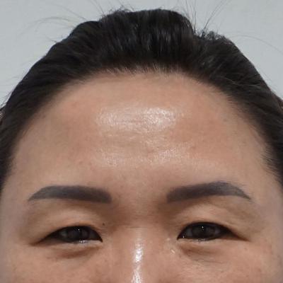 이마·눈 시술 44일차, 얼굴 작아지고 화장하는 게 즐거워요 사진 2 — 아바성형외과 이마거상 후기
