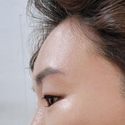 이마·눈 시술 44일차, 얼굴 작아지고 화장하는 게 즐거워요 사진 3 — 아바성형외과 이마거상 후기