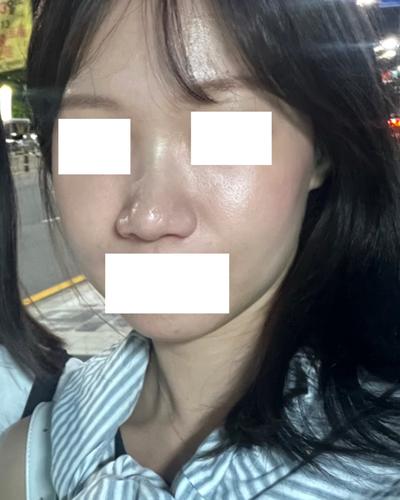 콧볼축소 2주차, 1～1.5mm만 줄였는데 앞모습이 달라졌어요 사진 2 — 아바성형외과 코성형 후기