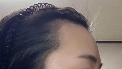 이마 흉터는 연고로 관리 중, 이마 좁아져서 너무 좋아요 — 아바성형외과 환자 후기 사진