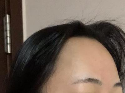 이마 흉터는 연고로 관리 중, 이마 좁아져서 너무 좋아요 사진 2 — 아바성형외과 이마거상 후기