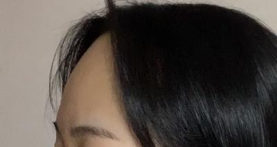 이마 흉터는 연고로 관리 중, 이마 좁아져서 너무 좋아요 사진 3 — 아바성형외과 이마거상 후기