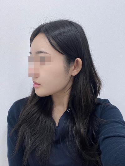 이중턱 시술 9주차, 턱살 빠져서 얼굴 훨씬 갸름해졌어요 — 아바성형외과 환자 후기 사진