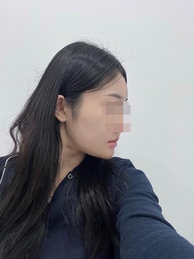 이중턱 시술 9주차, 턱살 빠져서 얼굴 훨씬 갸름해졌어요 사진 4 — 아바성형외과 이중턱·윤곽 후기
