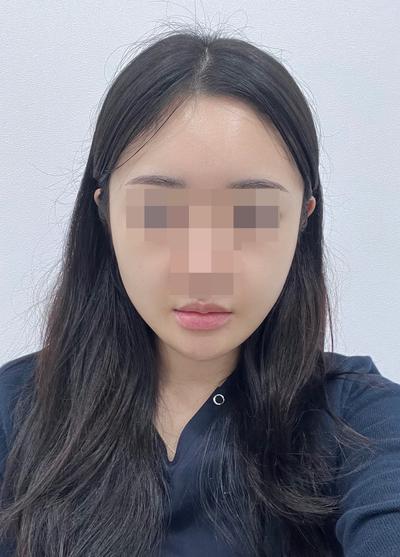 이중턱 시술 9주차, 턱살 빠져서 얼굴 훨씬 갸름해졌어요 사진 5 — 아바성형외과 이중턱·윤곽 후기