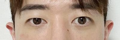 눈밑지방재배치 7주차, 많이 자연스러워져 만족해요 — 아바성형외과 환자 후기 사진