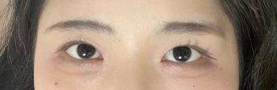 매몰 쌍꺼풀 후기, 원하던 인라인에 눈도 커졌어요 — 아바성형외과 환자 후기 사진