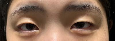 매몰 쌍꺼풀 후기, 원하던 인라인에 눈도 커졌어요 사진 2 — 아바성형외과 쌍꺼풀·눈성형 후기