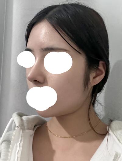 코재수술 상담 후기, 복코에 처진 코끝까지 짚어주셨어요 — 아바성형외과 환자 후기 사진