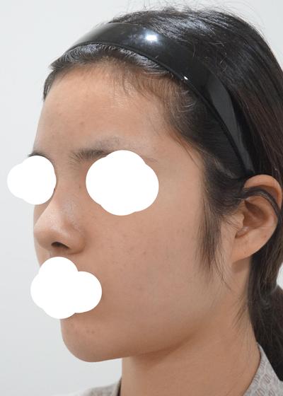 코재수술 상담 후기, 복코에 처진 코끝까지 짚어주셨어요 사진 2 — 아바성형외과 코성형 후기
