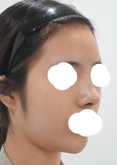 코재수술 상담 후기, 복코에 처진 코끝까지 짚어주셨어요 사진 3 — 아바성형외과 코성형 후기