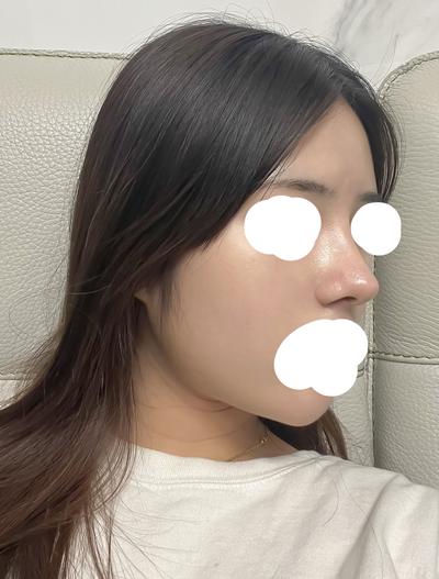 코재수술 상담 후기, 복코에 처진 코끝까지 짚어주셨어요 사진 4 — 아바성형외과 코성형 후기