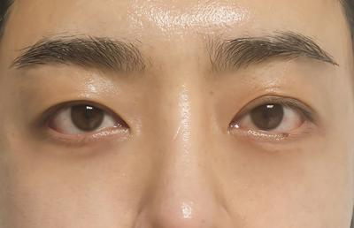 코성형 환자 후기 — ★브라운성형외과★ 김승수 원... (226)