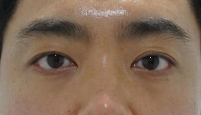 눈밑지방재배치+코성형 4주차, 피곤해 보이던 인상 달라졌어요 사진 2 — 아바성형외과 눈밑지방재배치 후기