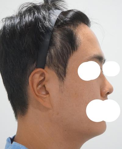 눈밑지방재배치+코성형 4주차, 피곤해 보이던 인상 달라졌어요 사진 3 — 아바성형외과 눈밑지방재배치 후기