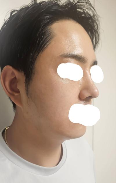 눈밑지방재배치+코성형 4주차, 피곤해 보이던 인상 달라졌어요 사진 5 — 아바성형외과 눈밑지방재배치 후기