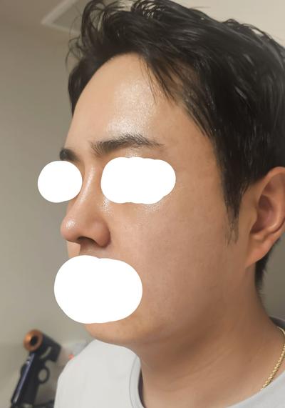 눈밑지방재배치+코성형 4주차, 피곤해 보이던 인상 달라졌어요 사진 6 — 아바성형외과 눈밑지방재배치 후기