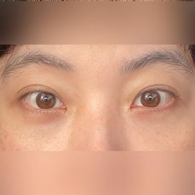 눈밑지방재배치 4주차, 눈밑 꺼짐 채워지니 인상이 확 밝아졌어요 — 아바성형외과 환자 후기 사진