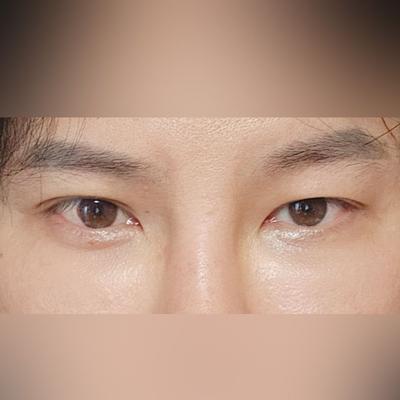 수술 2주 지났는데 3년은 젊어진 기분, 고민 마세요 — 아바성형외과 환자 후기 사진