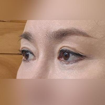 중안면거상+눈밑지방재배치 한달차, 10년은 젊어보여요 — 아바성형외과 환자 후기 사진