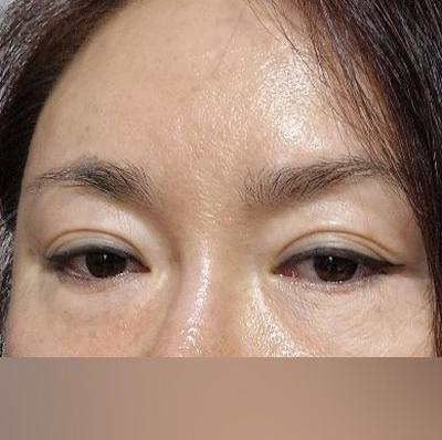 중안면거상+눈밑지방재배치 한달차, 10년은 젊어보여요 사진 2 — 아바성형외과 눈밑지방재배치 후기