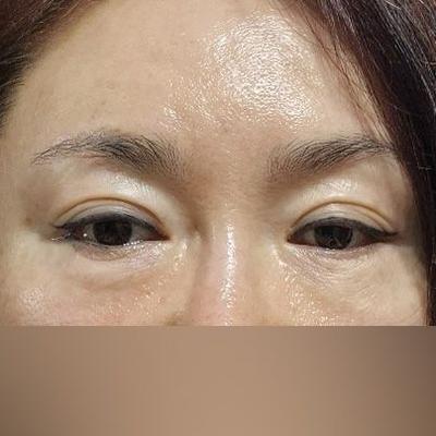 중안면거상+눈밑지방재배치 한달차, 10년은 젊어보여요 사진 3 — 아바성형외과 눈밑지방재배치 후기