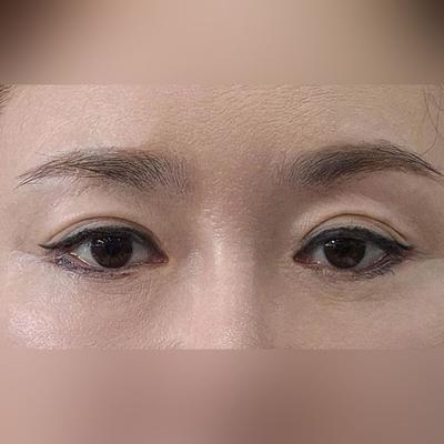 중안면거상+눈밑지방재배치 한달차, 10년은 젊어보여요 사진 4 — 아바성형외과 눈밑지방재배치 후기