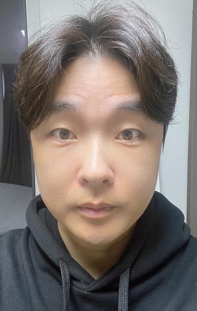첫 시술인데 6일차부터 붓기 확 빠지고 티도 안 나요 — 아바성형외과 환자 후기 사진