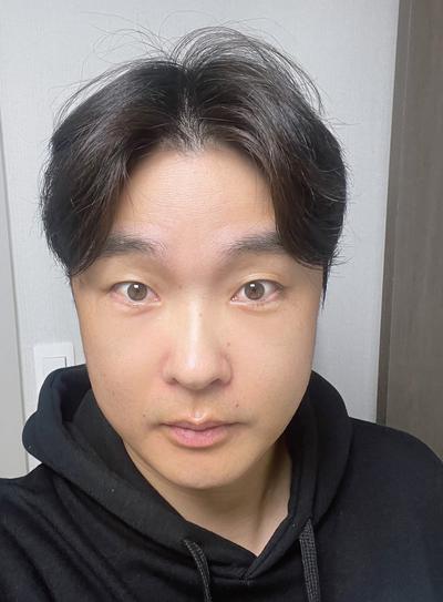 첫 시술인데 6일차부터 붓기 확 빠지고 티도 안 나요 사진 4 — 아바성형외과 기타 후기
