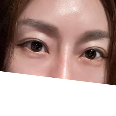눈밑지방재배치 2주차, 통증도 없고 좋아보인다는 말 들어요 — 아바성형외과 환자 후기 사진