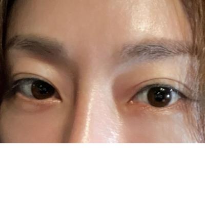눈밑지방재배치 2주차, 통증도 없고 좋아보인다는 말 들어요 사진 4 — 아바성형외과 눈밑지방재배치 후기