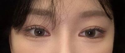 눈수술 9주차, 수술 전 눈이 기억도 안 날 만큼 자연스러워요 — 아바성형외과 환자 후기 사진