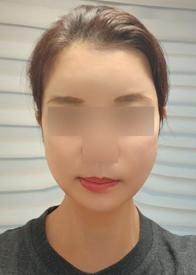 실리프팅 일주일차, 통증 거의 없고 붓기도 다 빠졌어요 — 아바성형외과 환자 후기 사진