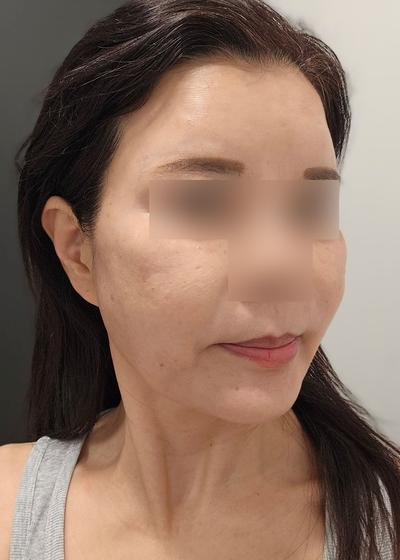 실리프팅 일주일차, 통증 거의 없고 붓기도 다 빠졌어요 사진 2 — 아바성형외과 안면거상 후기