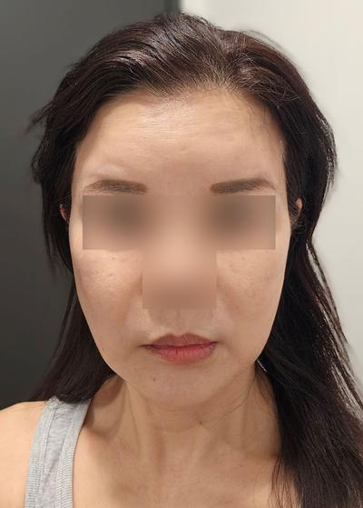 실리프팅 일주일차, 통증 거의 없고 붓기도 다 빠졌어요 사진 3 — 아바성형외과 안면거상 후기