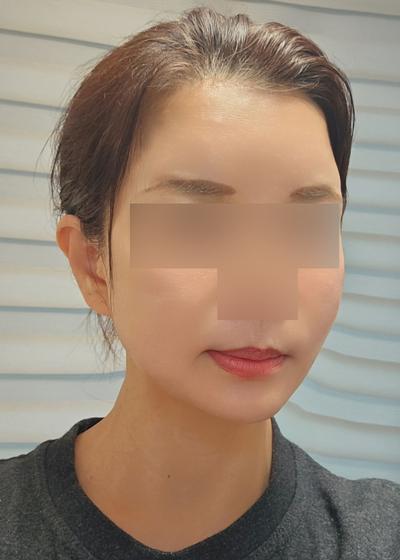 실리프팅 일주일차, 통증 거의 없고 붓기도 다 빠졌어요 사진 4 — 아바성형외과 안면거상 후기