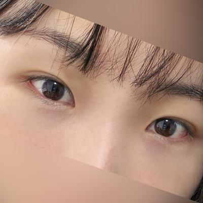 눈밑지방재배치 2주차, 컨실러 3겹 안 쌓아도 돼요 — 아바성형외과 환자 후기 사진