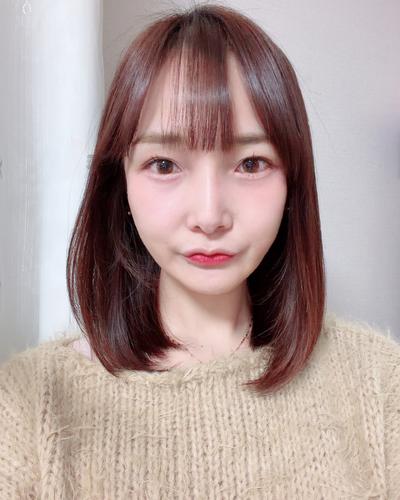 눈밑주름 꺼짐 고민 끝, 수술 10주차 효과 짱짱해요 — 아바성형외과 환자 후기 사진