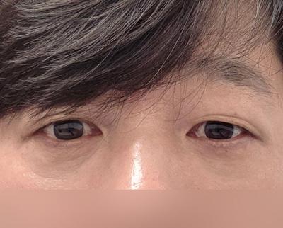 눈밑지방재배치 2개월차, 거의 다 회복되고 자리 잘 잡았어요 — 아바성형외과 환자 후기 사진