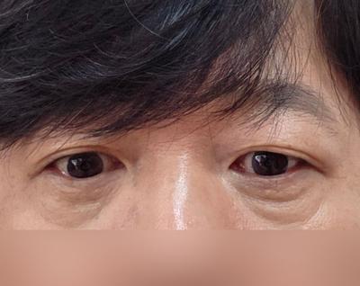 눈밑지방재배치 2개월차, 거의 다 회복되고 자리 잘 잡았어요 사진 2 — 아바성형외과 눈밑지방재배치 후기