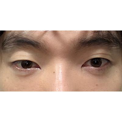 6주차 후기, 붓기 다 빠져서 생활 진짜 편해요 — 아바성형외과 환자 후기 사진
