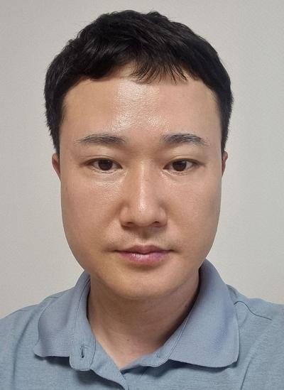 눈밑지방재배치에 하안검까지, 피곤해 보인다는 말 들어서 했어요 — 아바성형외과 환자 후기 사진