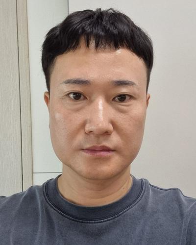 눈밑지방재배치에 하안검까지, 피곤해 보인다는 말 들어서 했어요 사진 2 — 아바성형외과 눈밑지방재배치 후기