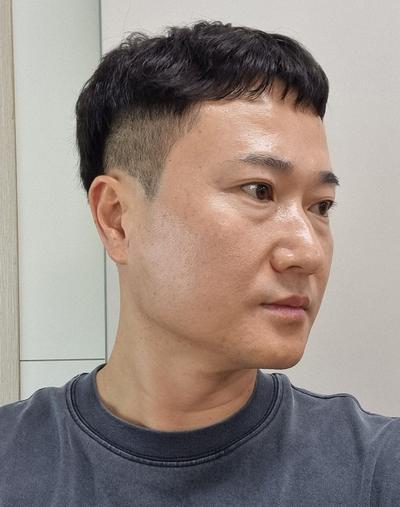 눈밑지방재배치에 하안검까지, 피곤해 보인다는 말 들어서 했어요 사진 3 — 아바성형외과 눈밑지방재배치 후기